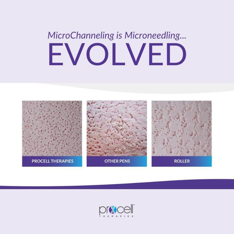 Procell Tip Why Procell Microchanneling Is Better Than Traditional Microneedling ...